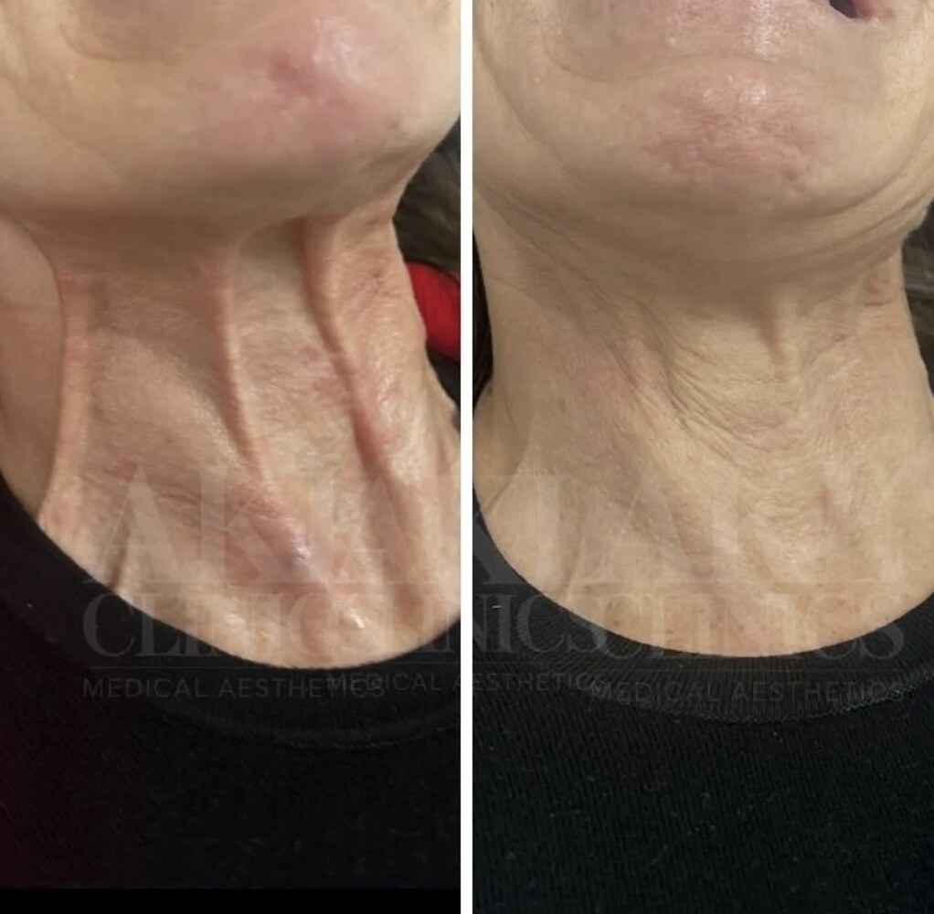 Botulinum Toxin