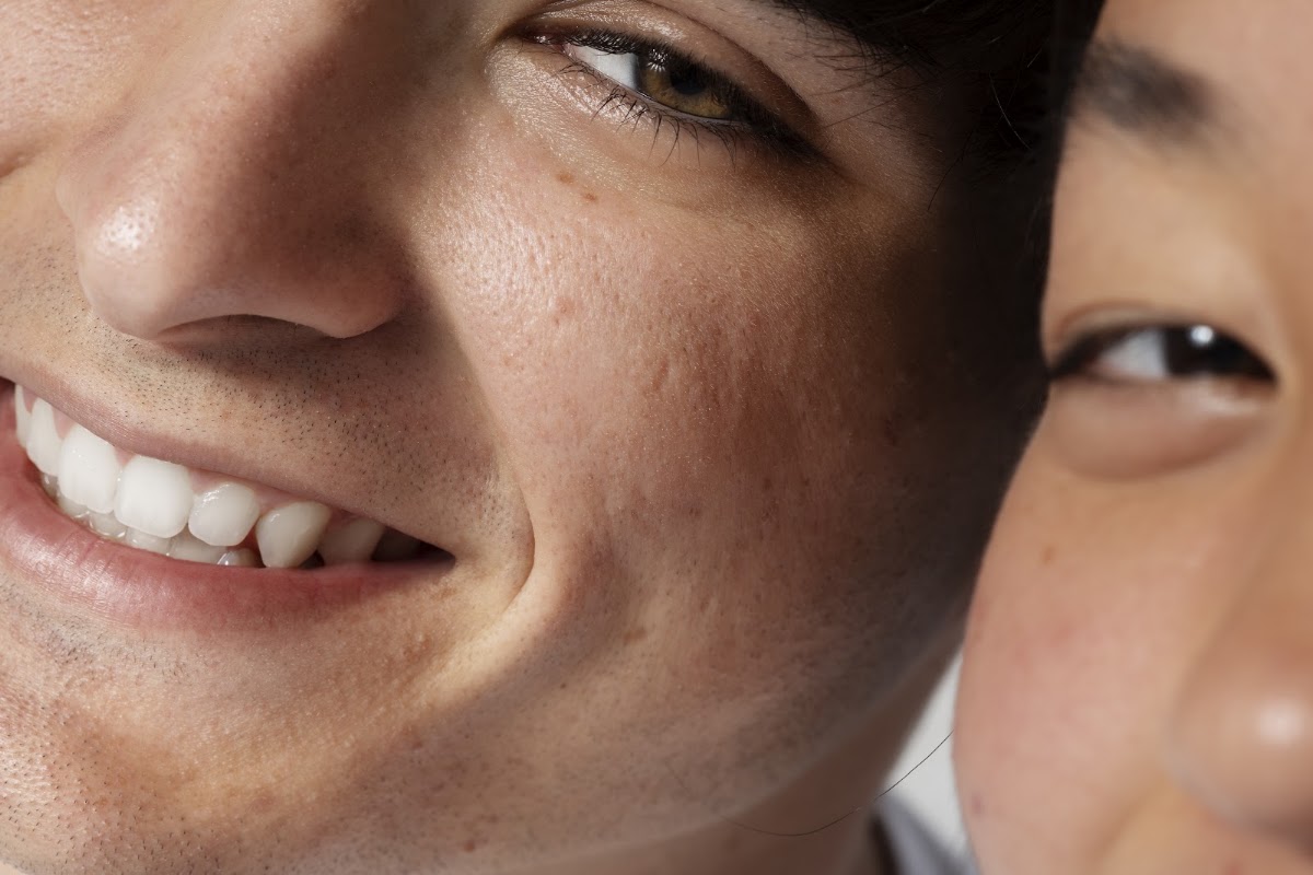 Cynosure Laser Advanced Treatments