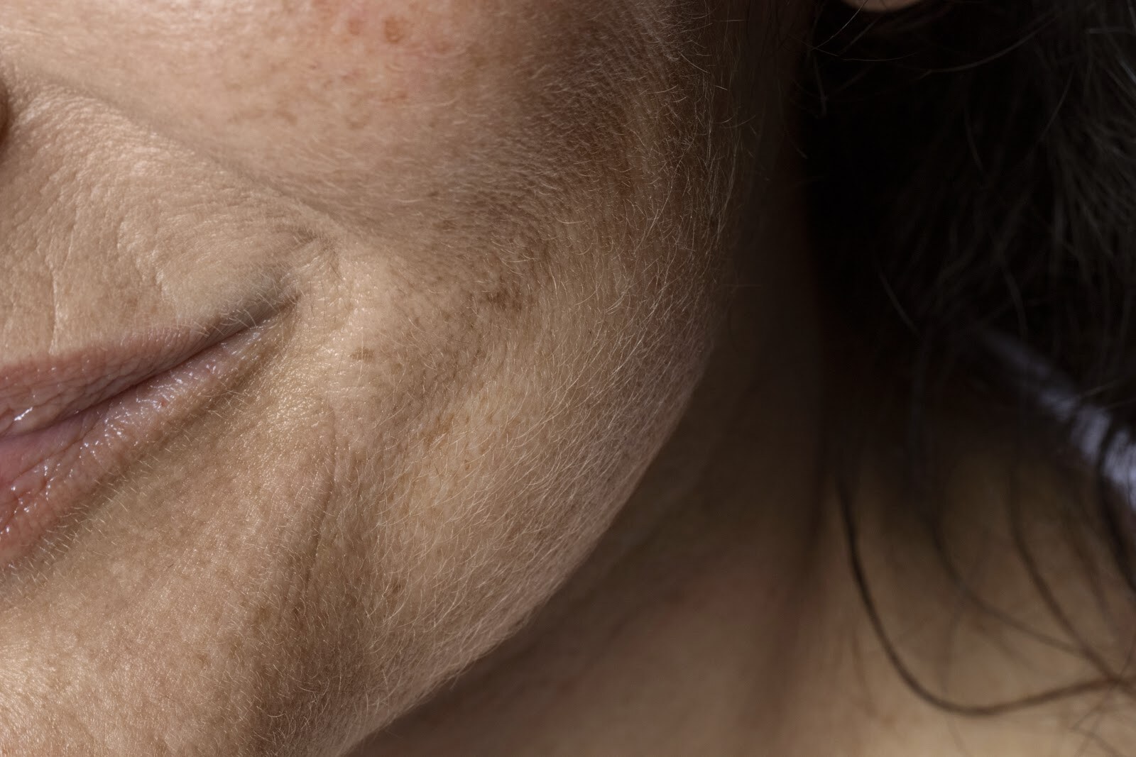 Nasolabial Folds Filler
