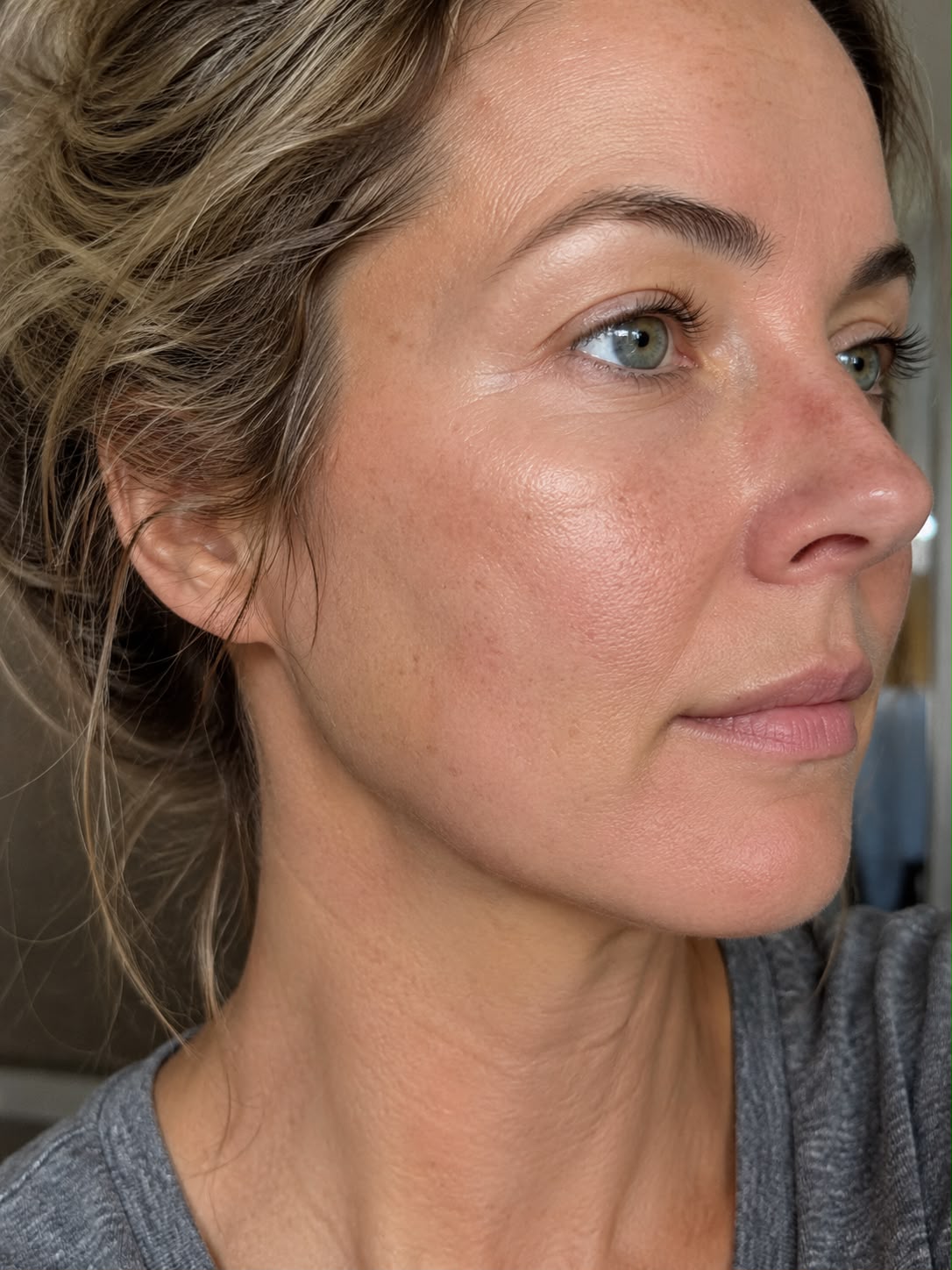 Sculptra - Reverse the Sag
