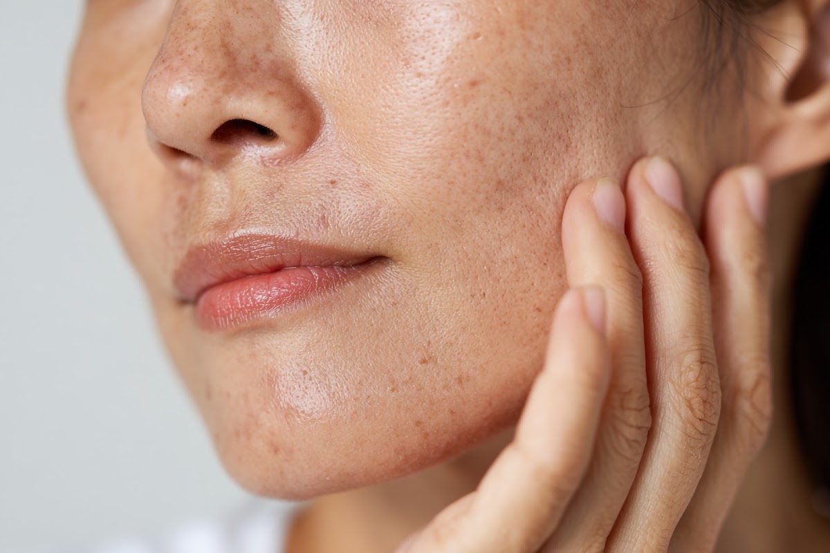 Easytech Tca Spot Peel